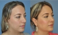 Revision rhinoplasty (correction of a previously operated nose by other surgeon)